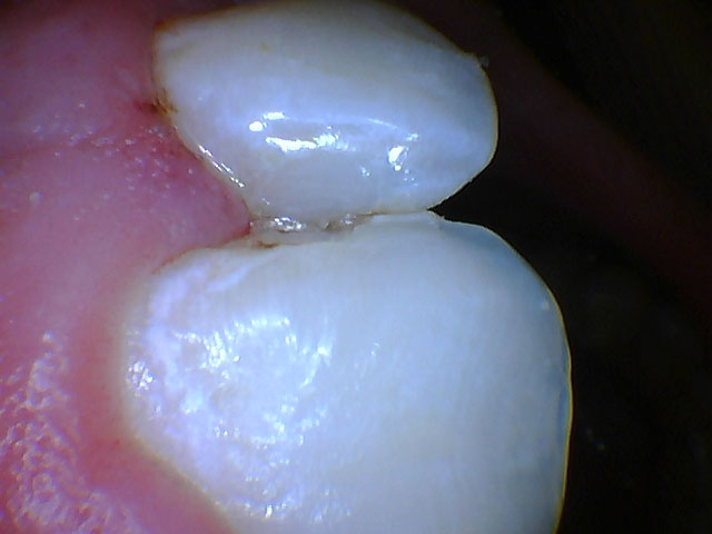 after tooth colored filling procedure