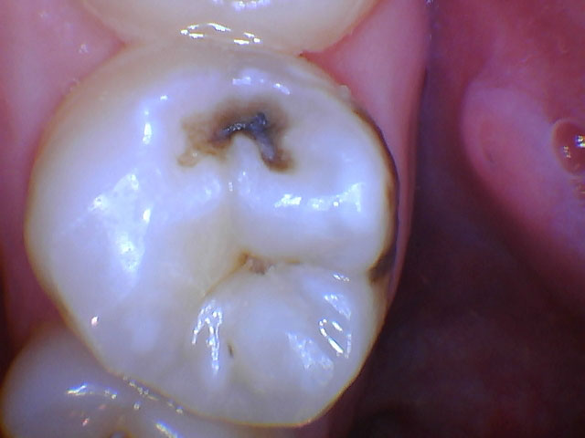 before tooth colored filling procedure